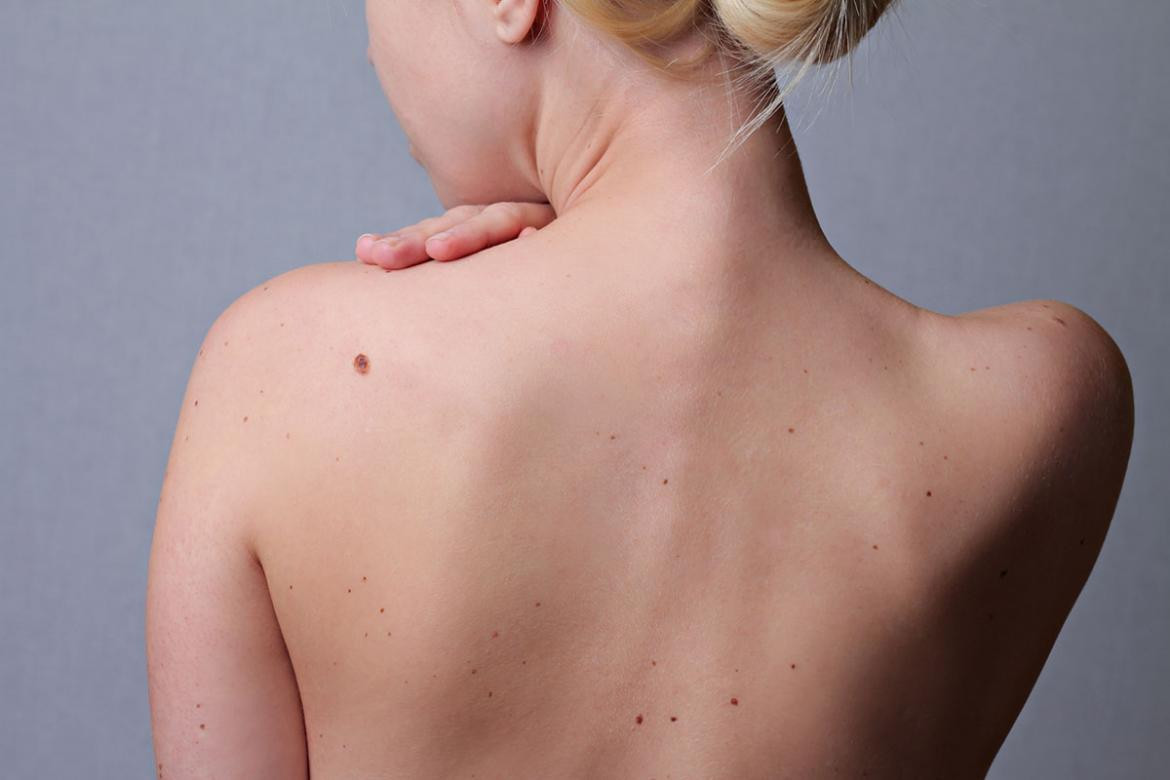 Melanoma - Cáncer de piel
