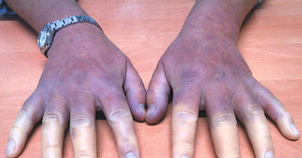 Esclerodermia - Enfermedad de las manos azules