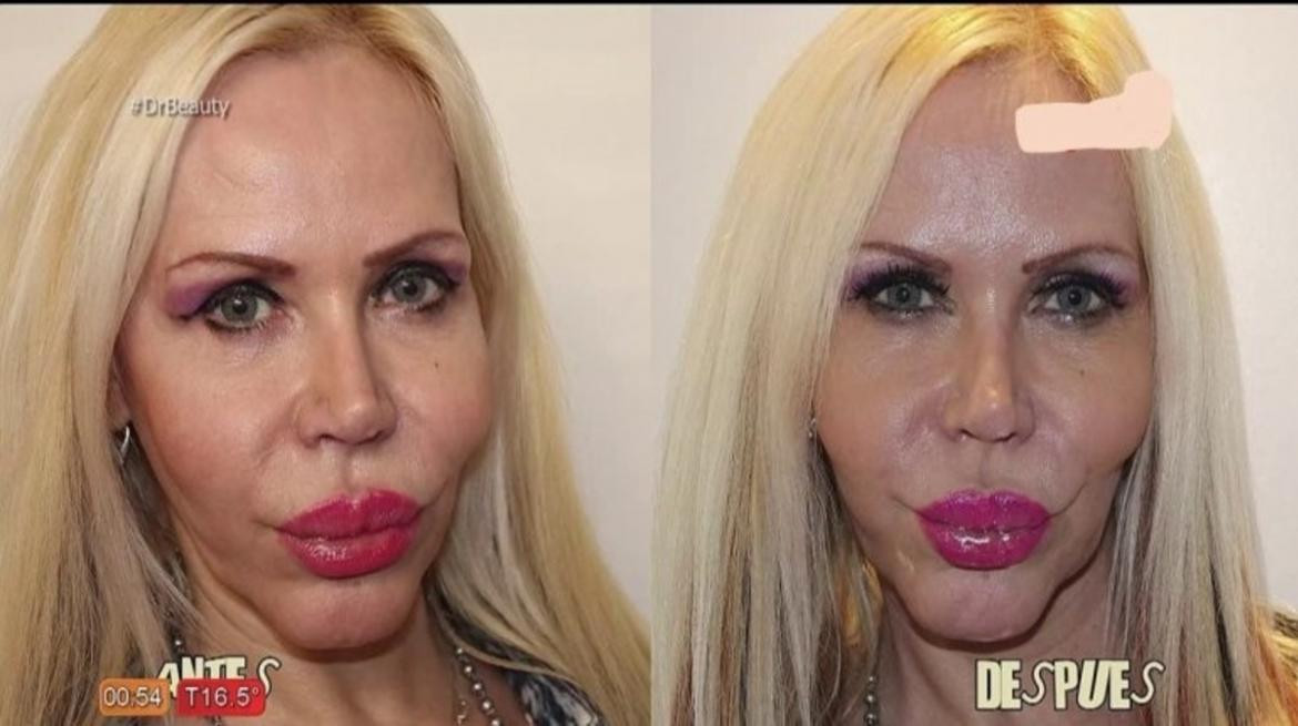Alejandra Pradón, nuevo rostro y rejuvenecimiento vaginal