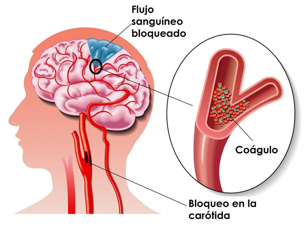 Salud - ACV