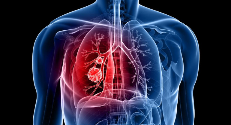 Salud - Cáncer pulmón