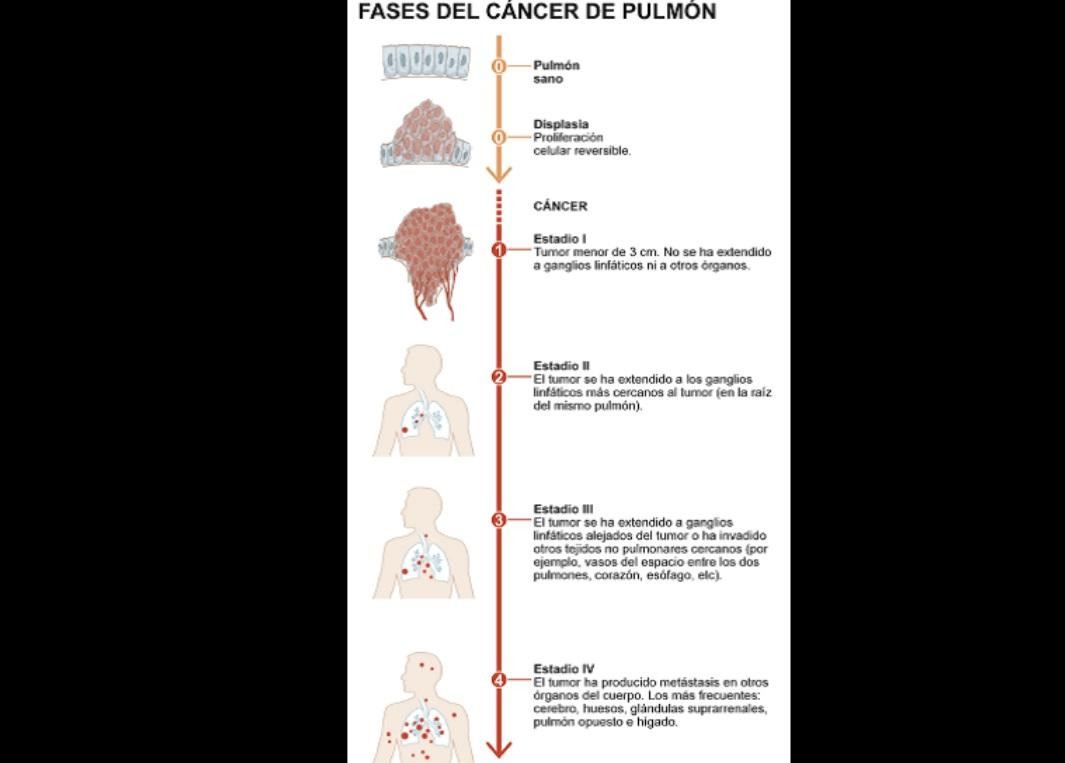 Cáncer pulmón - Salud