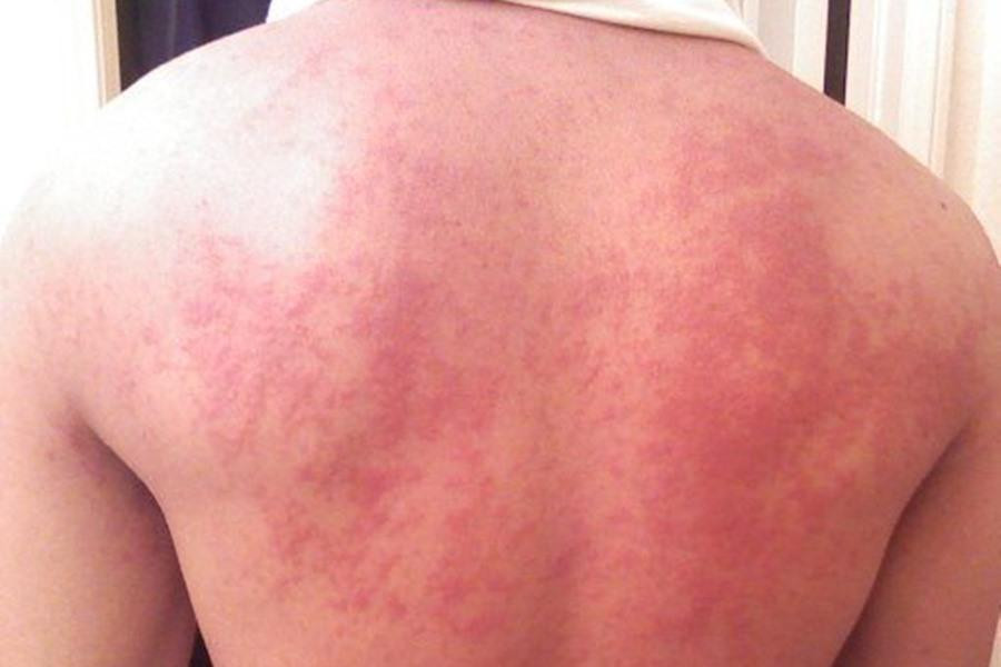 Dermatitis atópica: una enfermedad inflamatoria frecuente de la piel