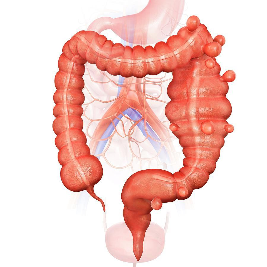 Diverticulitis: el trastorno intestinal que inflama o infecta el intestino