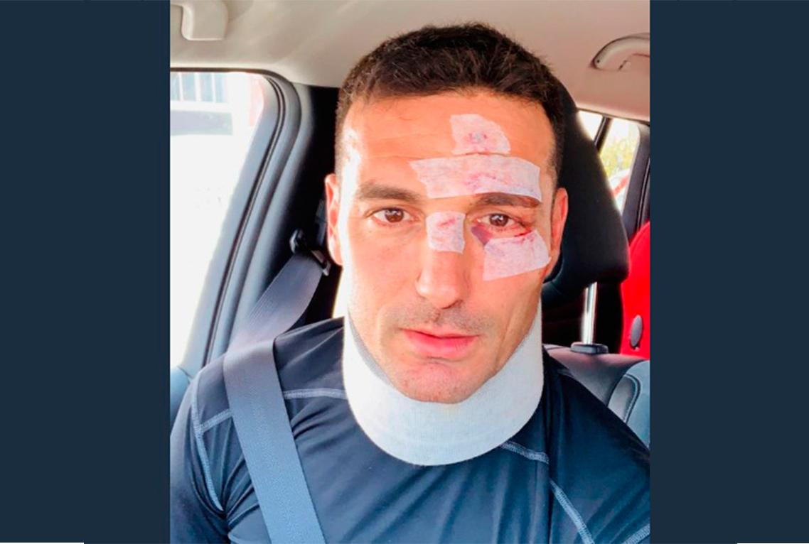 Lionel Scaloni tras accidente vial en Mallorca