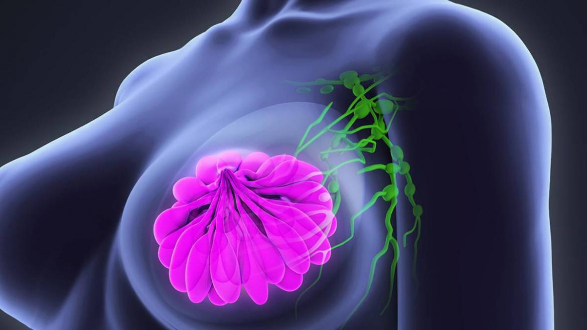 Presentaron un tratamiento que prolonga la vida de mujeres con cáncer de mama