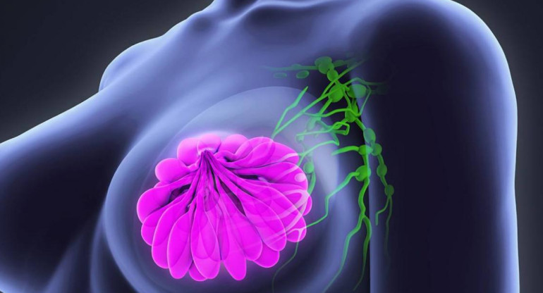 Presentaron un tratamiento que prolonga la vida de mujeres con cáncer de mama