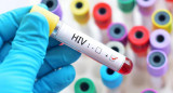 HIV