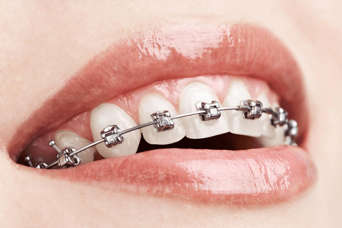 Brackets