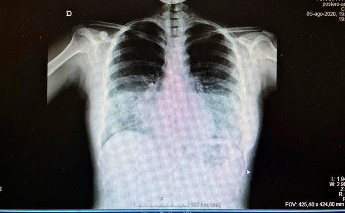 Coronavirus en España, radiografía de pulmones, salud