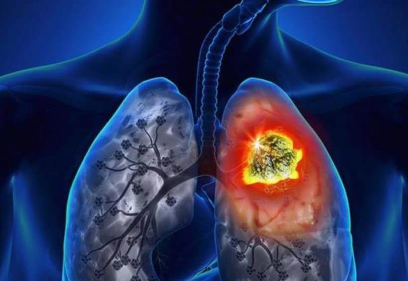 Cáncer de pulmón, salud