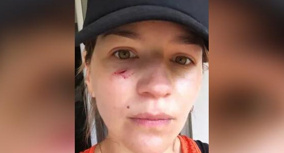 Marcela Kloosterboer sufrió heridas en su rostro