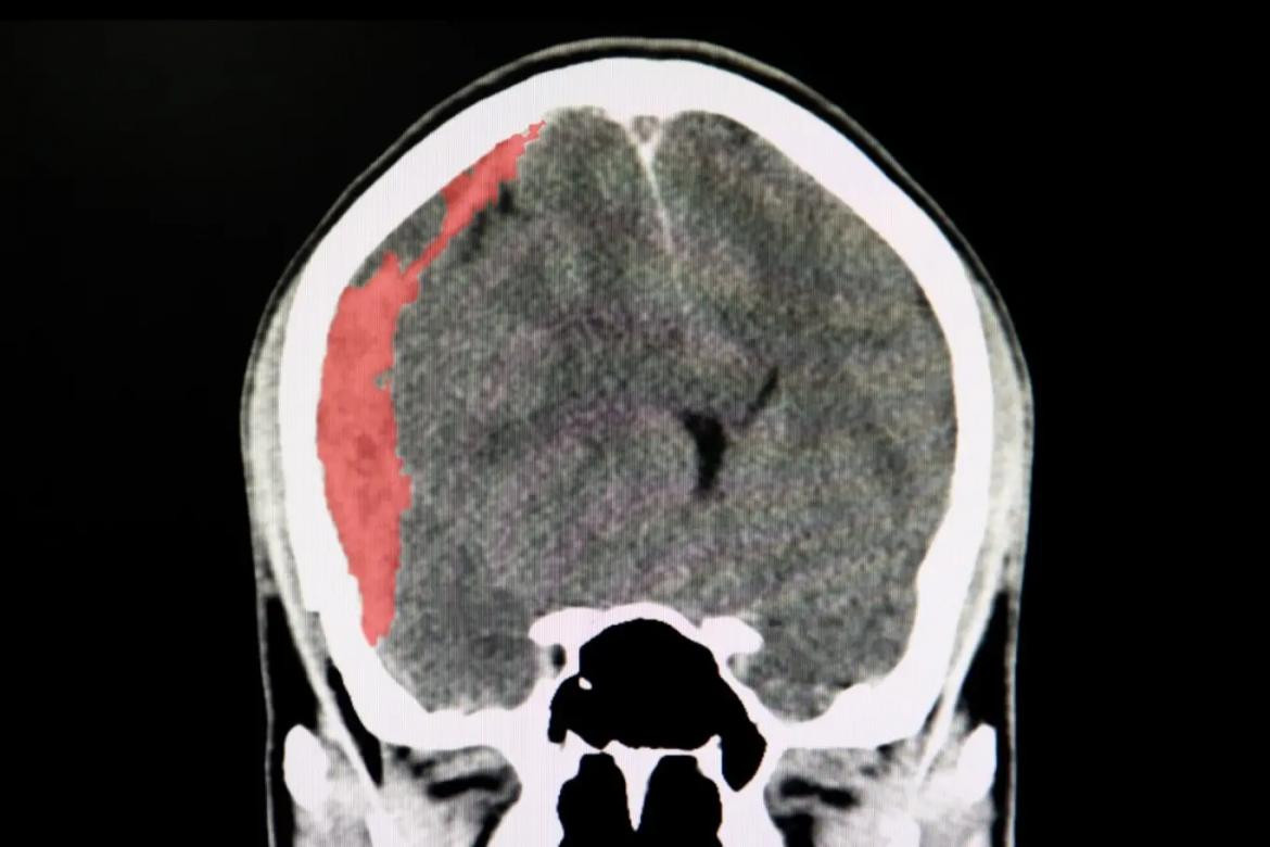 Hematoma subdural crónico, salud