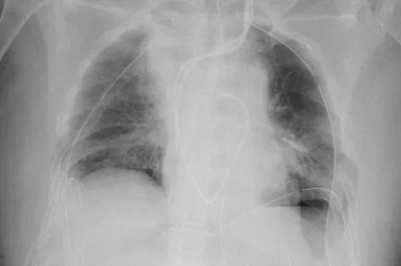 Venció al coronavirus y le trasplantaron los pulmones de su esposo e hijo