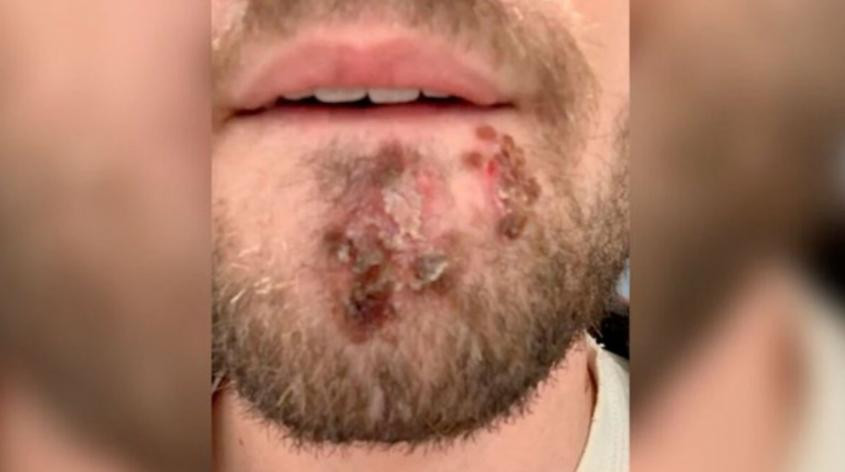 Usó afeitadora de un amigo y se contagió de una bacteria carnívora, NA