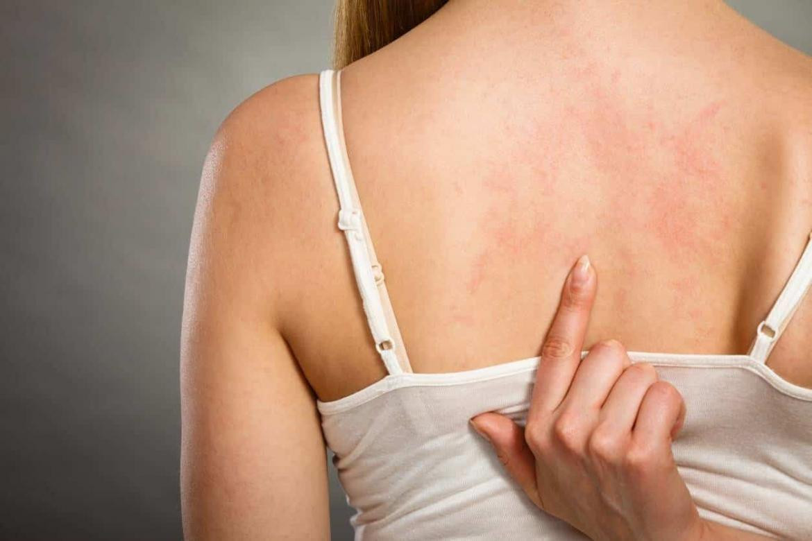 Dermatitis atópica, enfermedad de la piel, salud