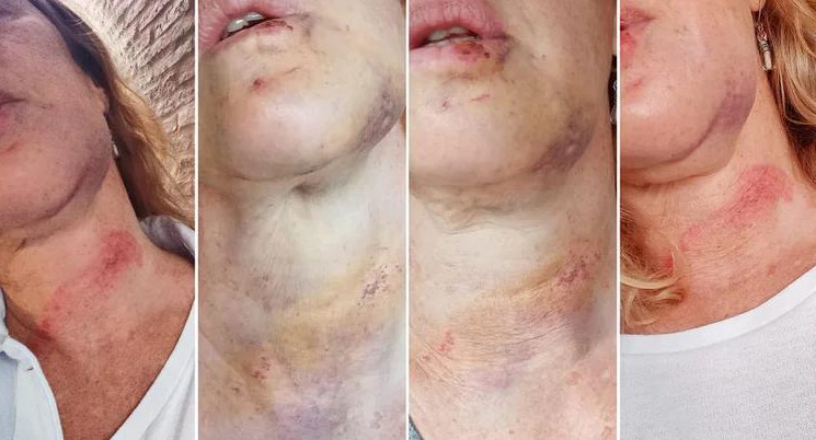 Una mujer muestra las heridas que le dejó un hombre en Belgrano R, foto NA