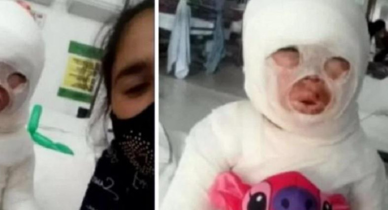 Florencio Varela: una empleada de un restaurante se tropezó y le volcó aceite hirviendo a una nena de 3 años