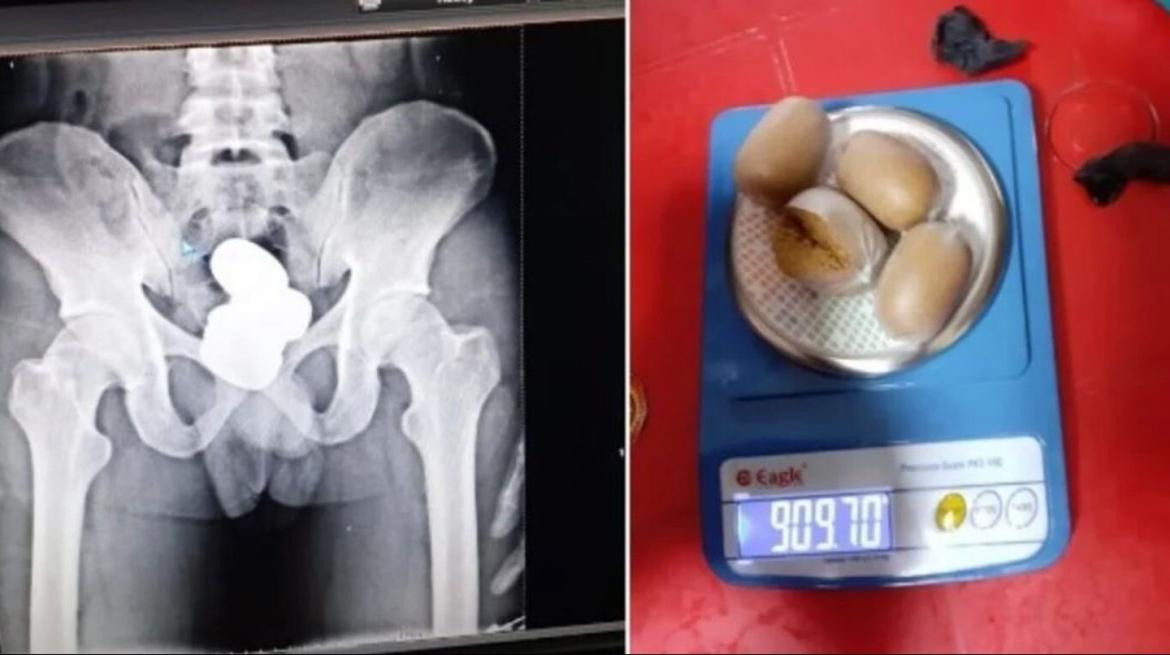 Un hombre de la India quedó detenido por llevar un kilo de oro en su estómago. Foto: RT.