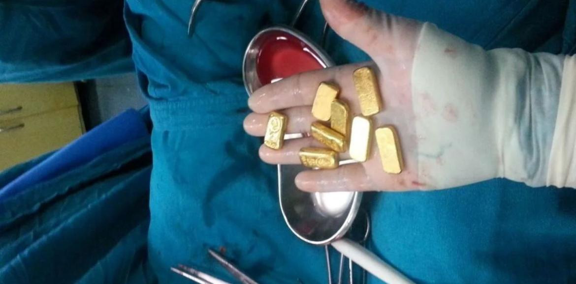 El oro encontrado dentro del estómago del hombre indio. Foto: RT.