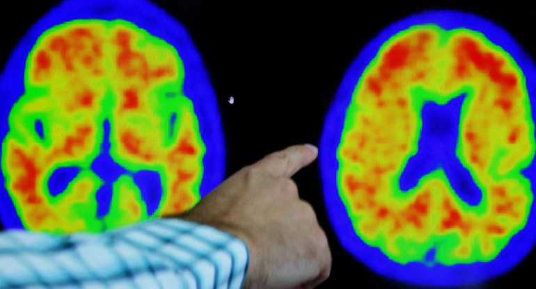 Alzheimer, salud. Foto: Reuters