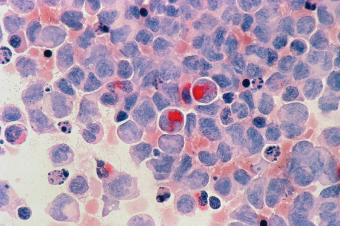 Células cancerosas. Foto: Unsplash