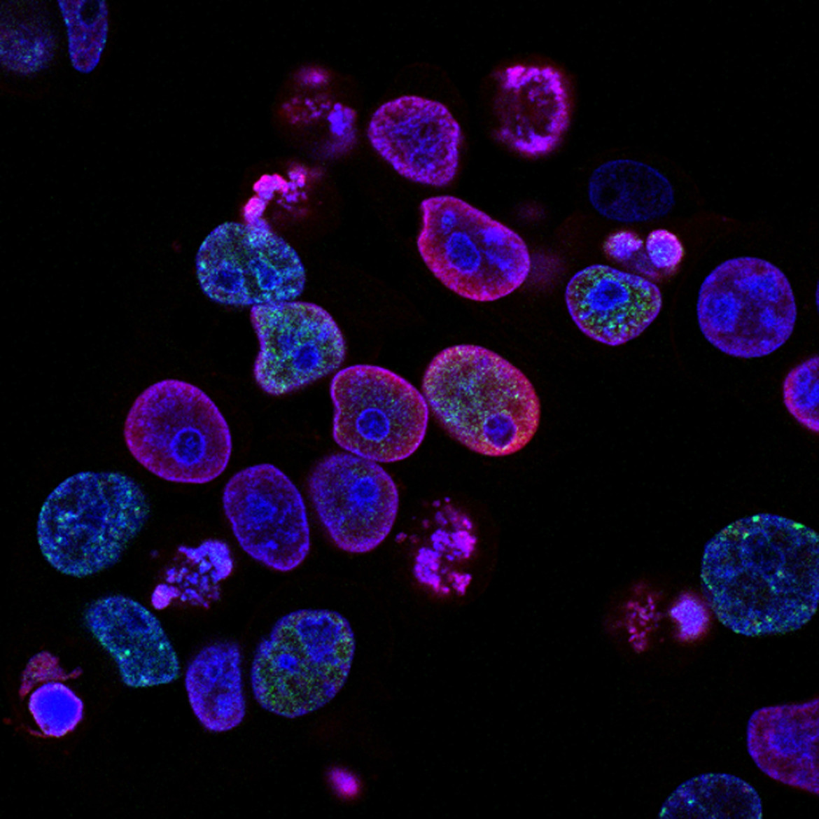 Células malignas de cáncer. Foto: Unsplash