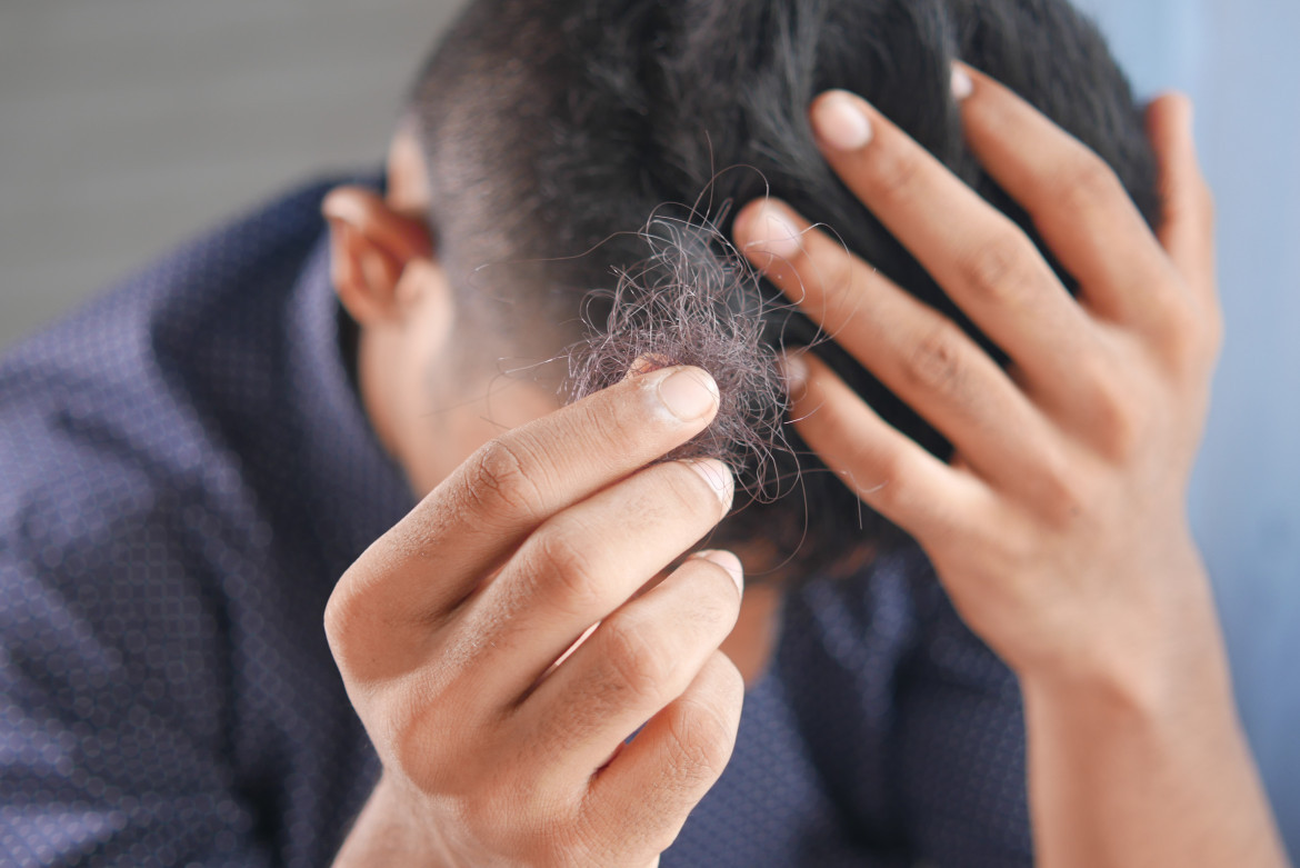 Caída de pelo, alopecia. Foto: Unsplash