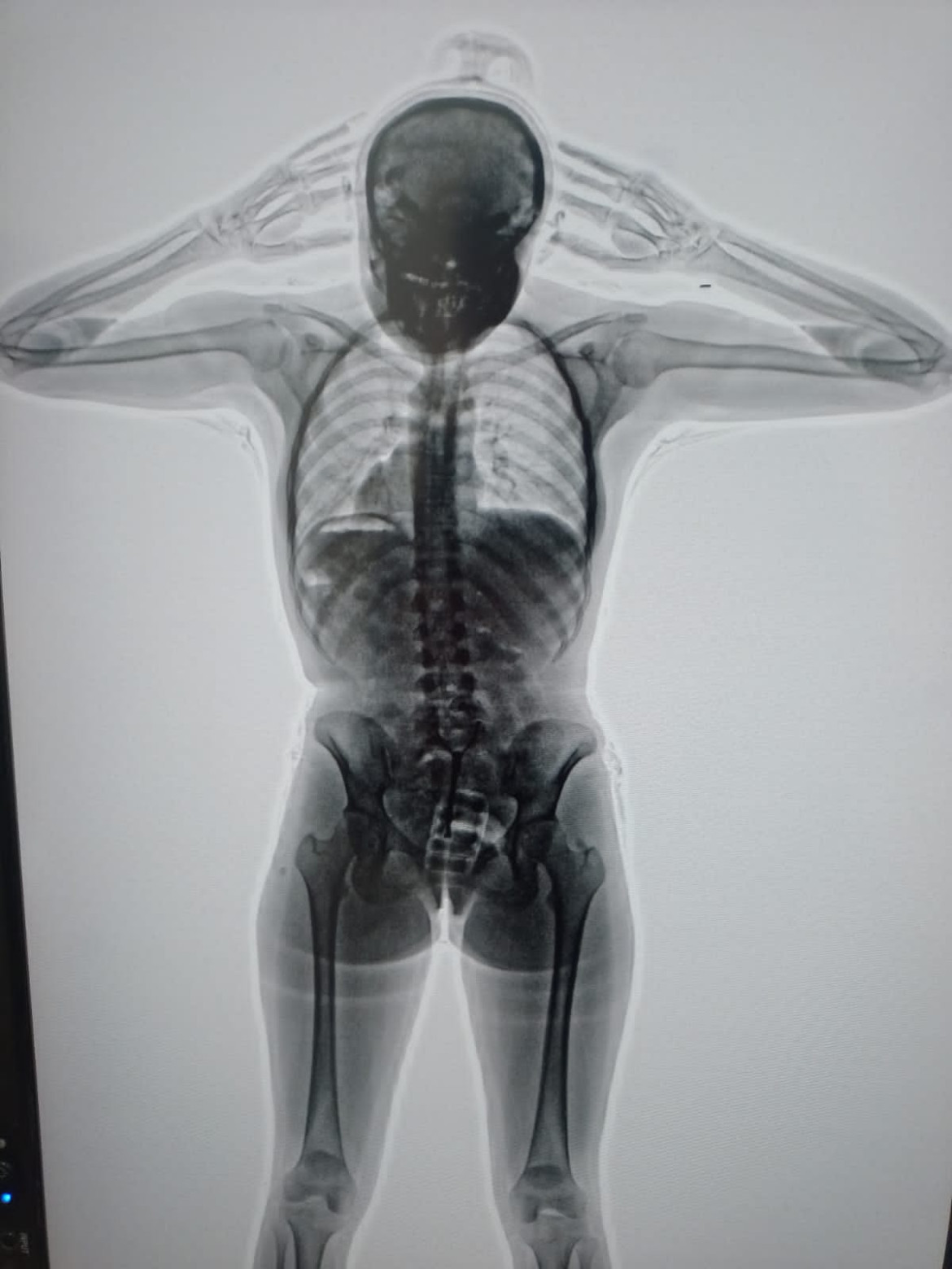 El body scan que detectó la presencia de cocaína en el cuerpo de la detenida. Foto: PSA.