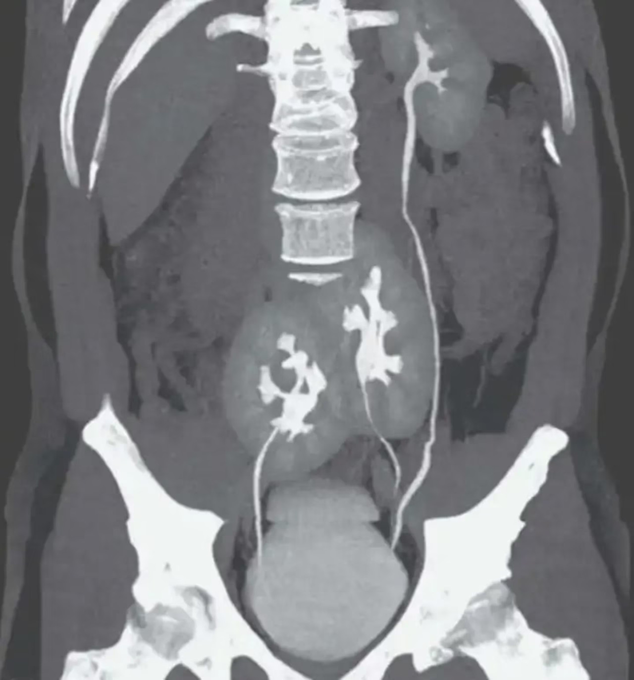 La tomografía donde se vieron los tres riñones. Foto: New England Journal of Medicine