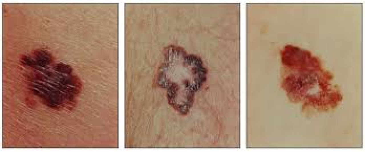 Tipos de melanoma. Foto: National Cancer Institute