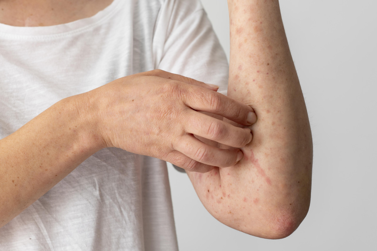 Urticaria por estrés. Foto: Freepik.