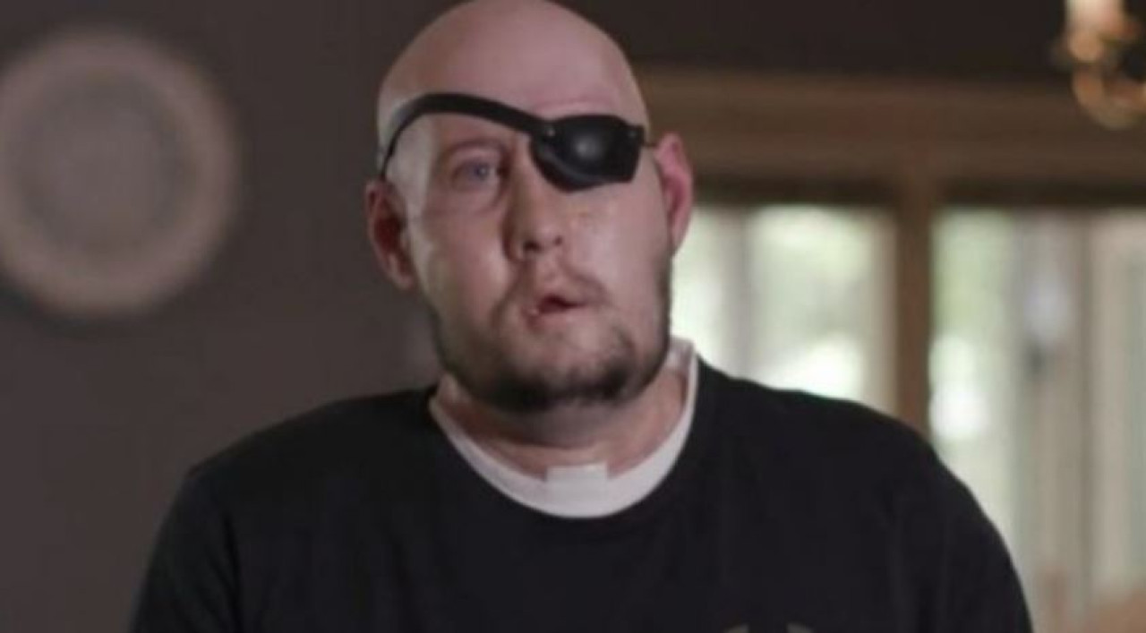 Aaron James, un paciente de 46 años que sobrevivió a una intensa descarga eléctrica por la que perdió su ojo izquierdo. Foto: NA
