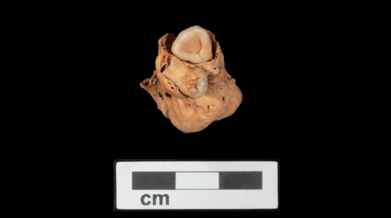 El teratoma ovárico con dientes encontrado en Egipto. Foto: Proyecto Amarna