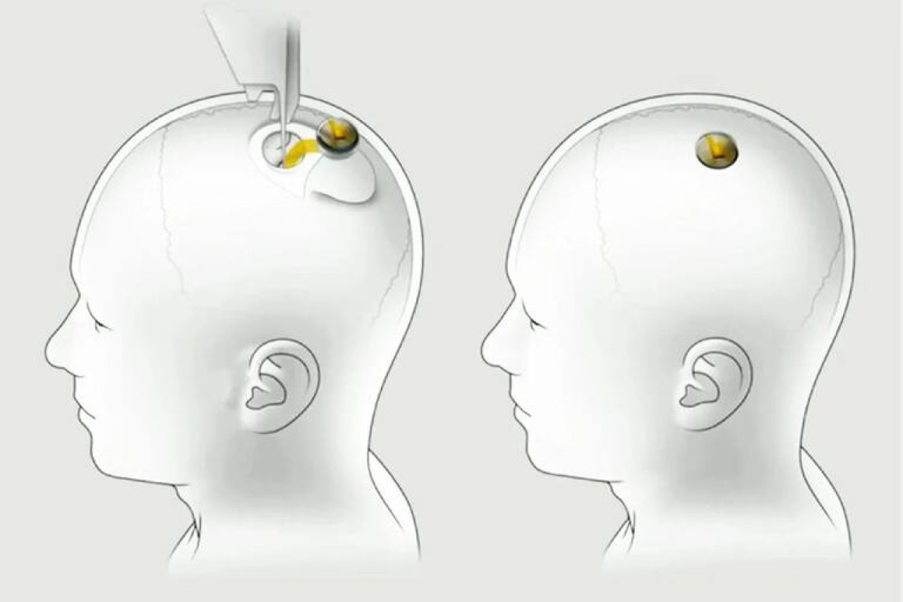 Inserción de Neuralink de chips cerebrales en humanos.