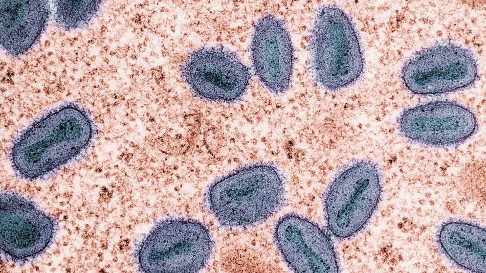 Mpox, viruela símica. Foto: Unsplash.