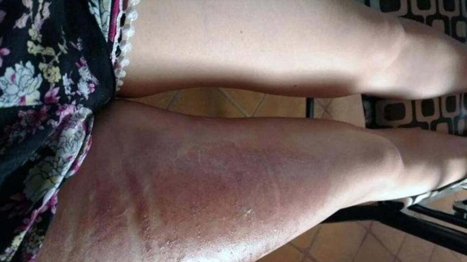 Quemaduras de joven de Río Negro por líquido de funda de celular
