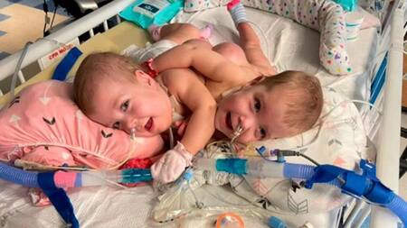 La emocionante historia de las siamesas Altobelli