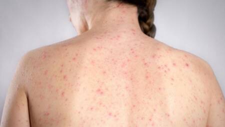 Investigan los contactos directos de la joven embarazada contagiada de sarampión en el exterior