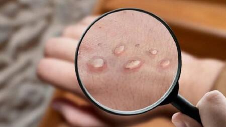 Viruela del mono. Foto: NA.