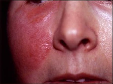 Erisipela, infección cutánea. Foto: MedicinePlus.