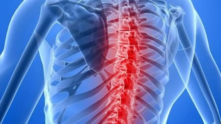 Atrofia muscular espinal. Foto: NA.