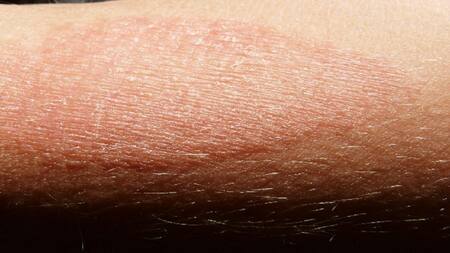 Dermatitis atópica, salud, medicina