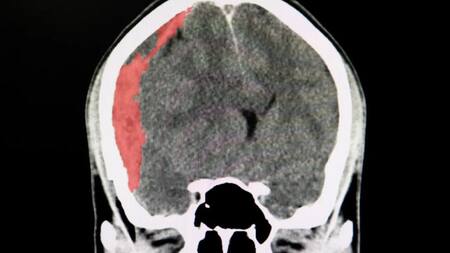 Hematoma subdural crónico, salud