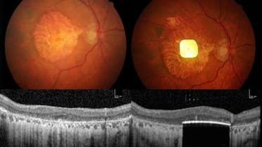 Histórico logro en la medicina: con un microchip y anteojos especiales,  más de 30 pacientes recuperaron la vista