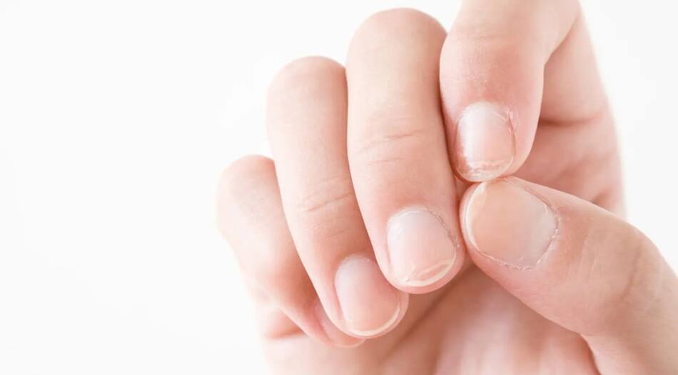 grietas en las uñas. Fuente: Captura