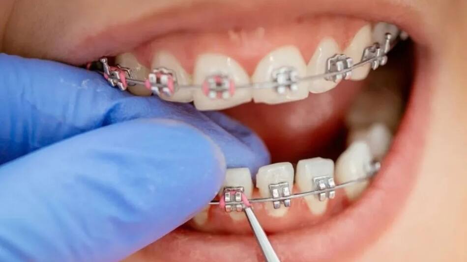Brackets.