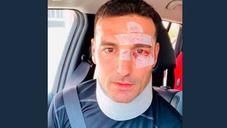 Lionel Scaloni tras accidente vial en Mallorca