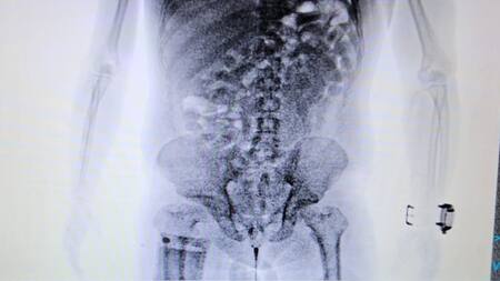 Aduana detuvo a un hombre que viaja a Europa con 84 cápsulas de cocaína en su organismo. Foto: Aduana.