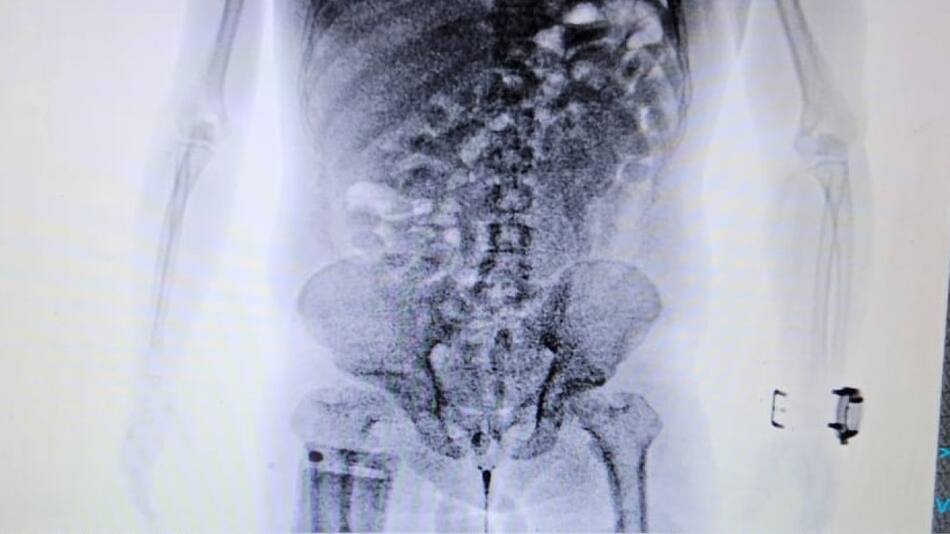 Aduana detuvo a un hombre que viaja a Europa con 84 cápsulas de cocaína en su organismo. Foto: Aduana.